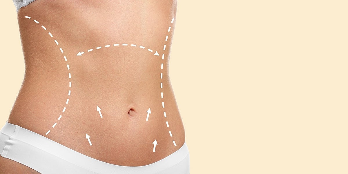 Diagram illustrating abdominal body contouring.