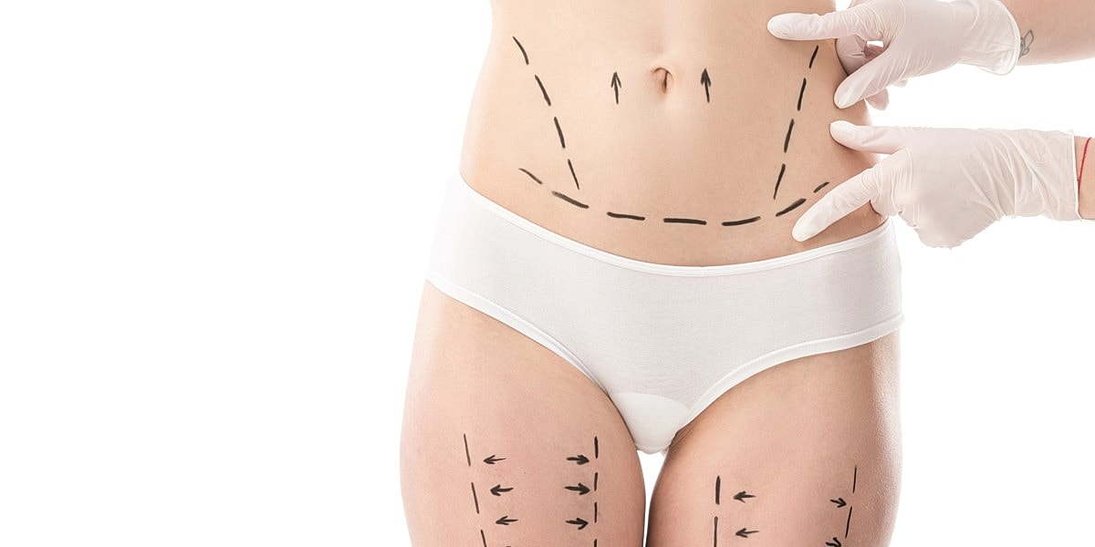 Body contouring markings on a woman's abdomen.
