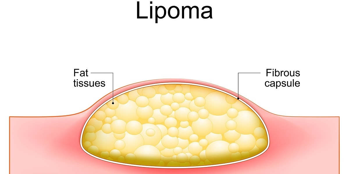 Illustration of a lipoma structure and components.