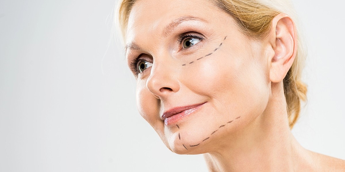 Woman with facial markings for cosmetic procedure.