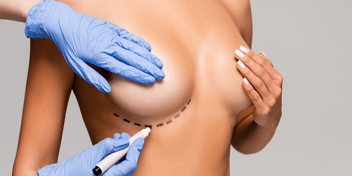 Preparation for breast surgery with marker markings.
