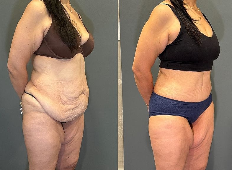 Before and after body transformation comparison.