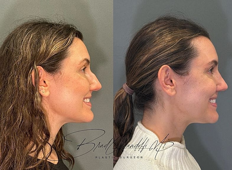 Before and after profile of a cosmetic procedure