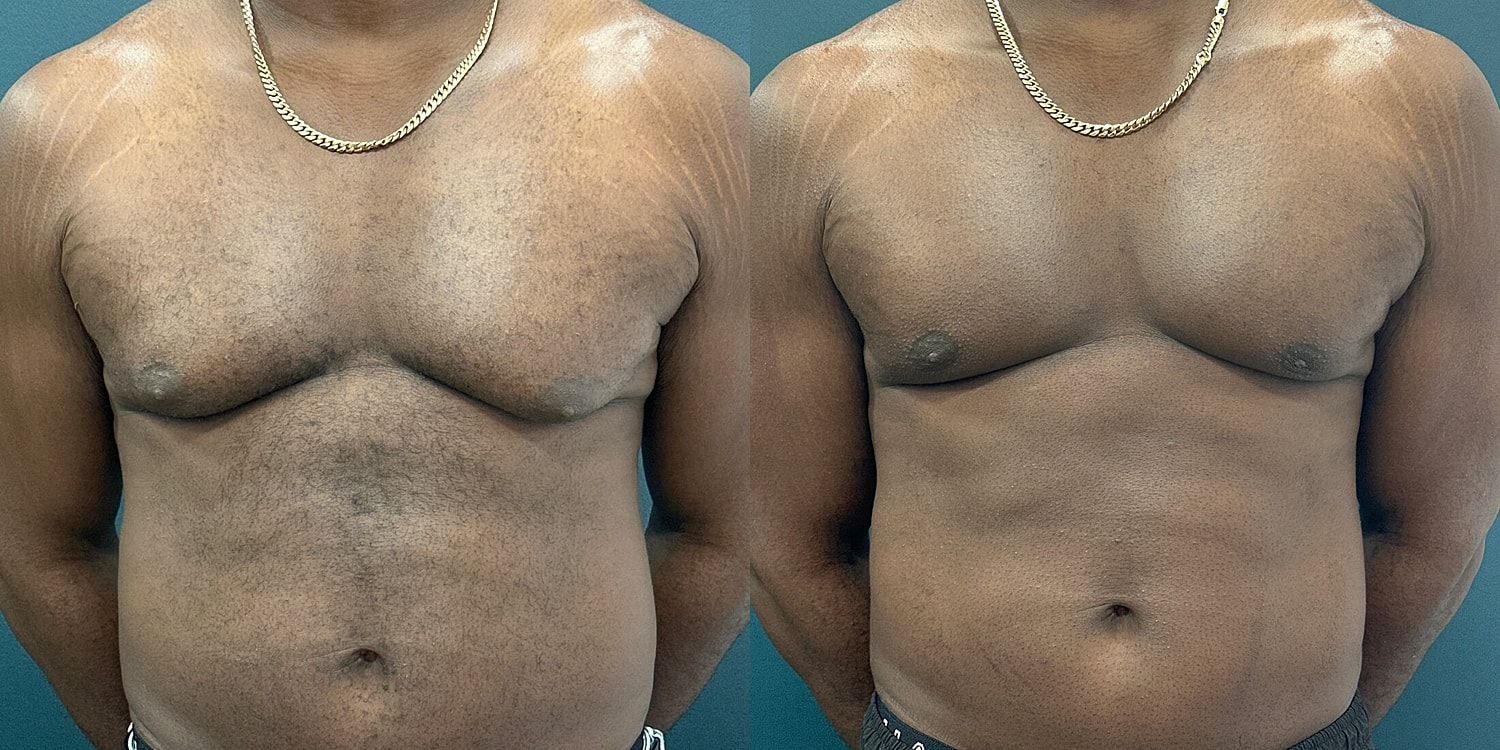 Gynecomastia Before & After