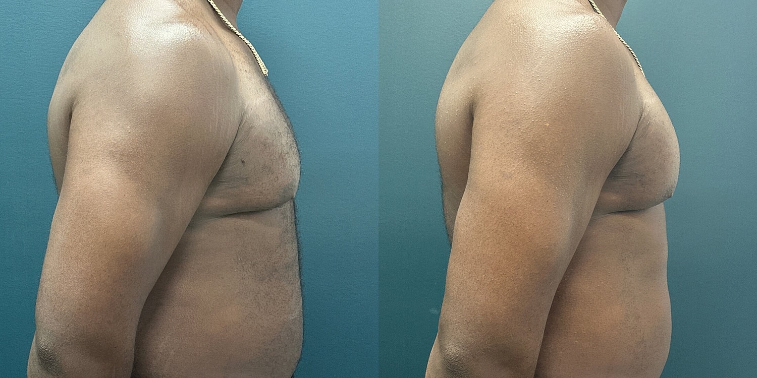 Gynecomastia Before & After