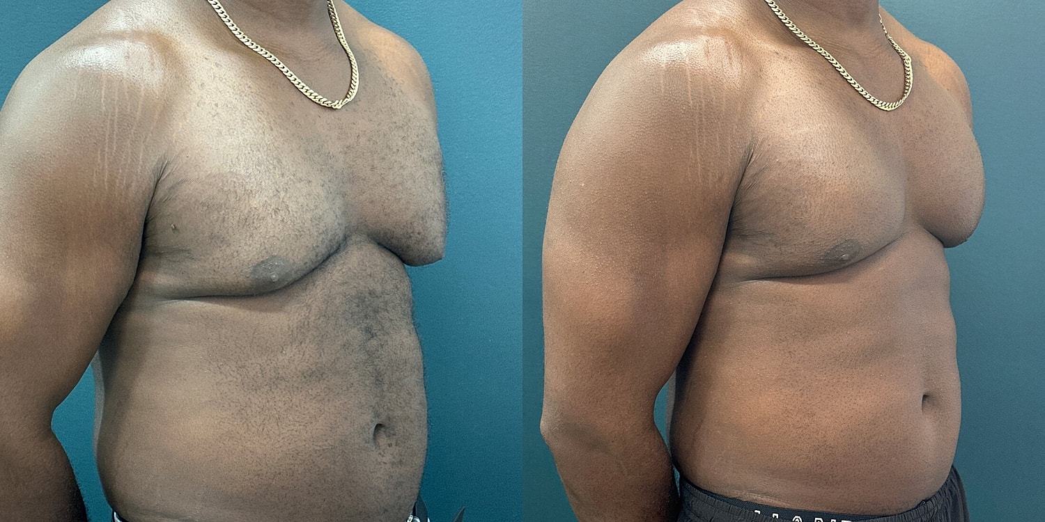 Gynecomastia Before & After