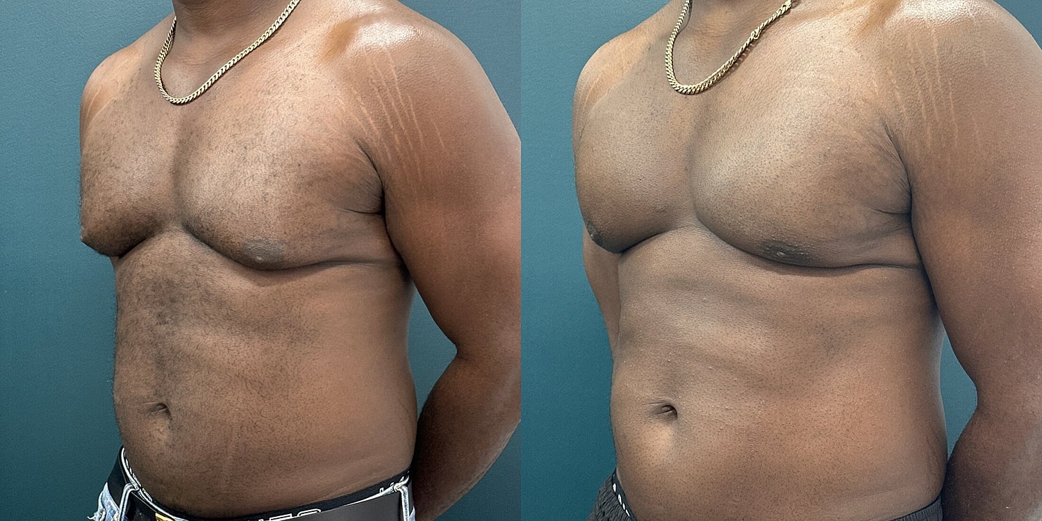 Gynecomastia Before & After