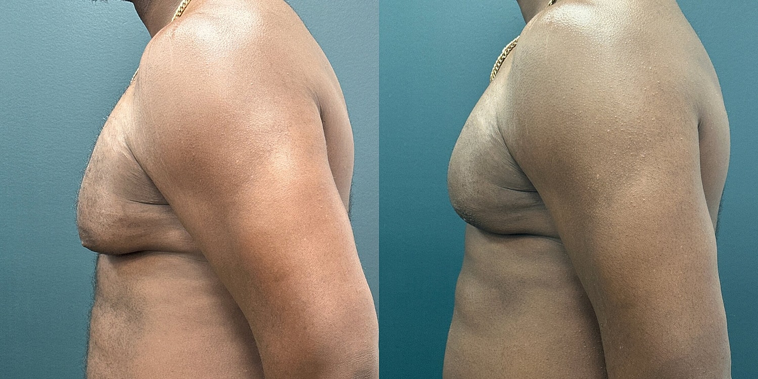 Gynecomastia Before & After