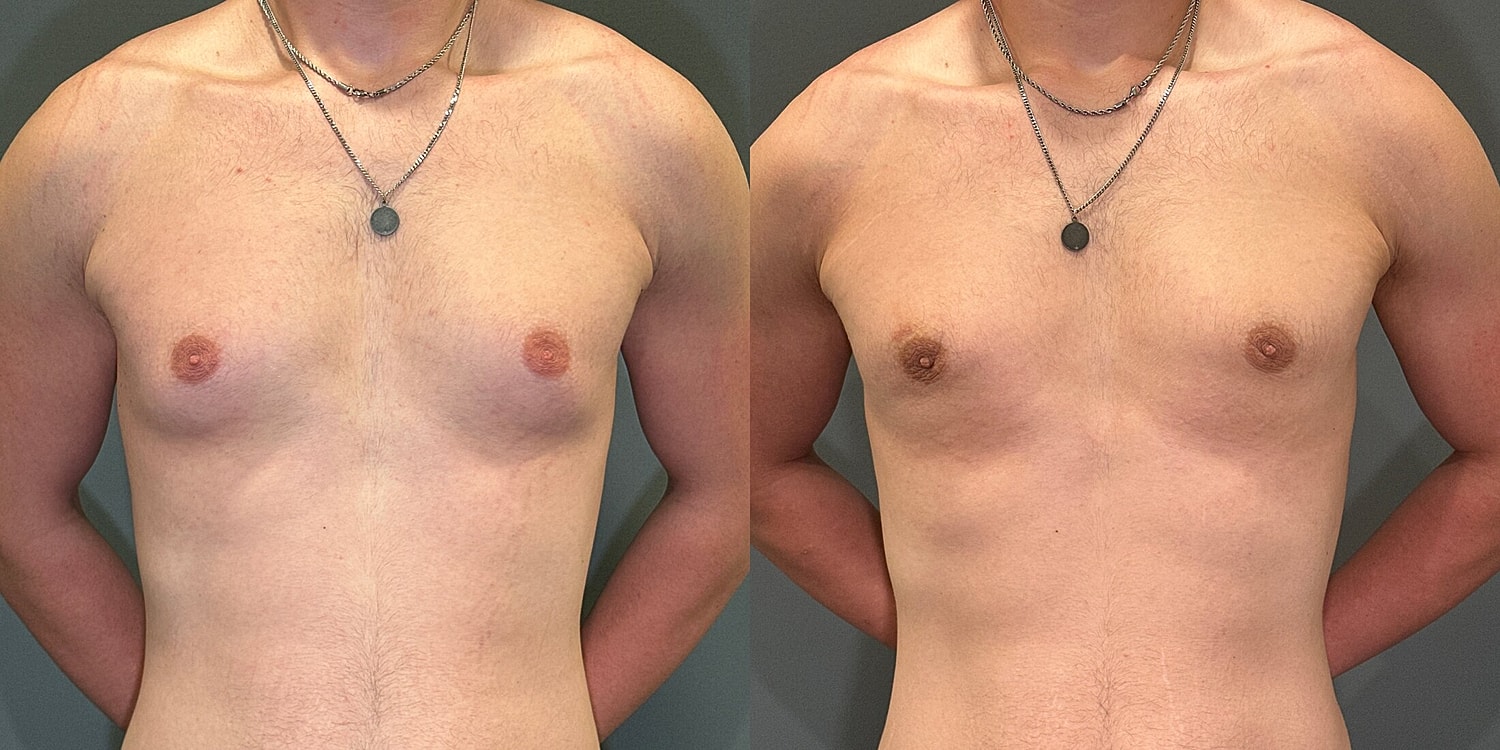 Gynecomastia Before & After