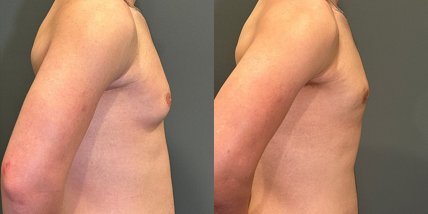Gynecomastia Before & After