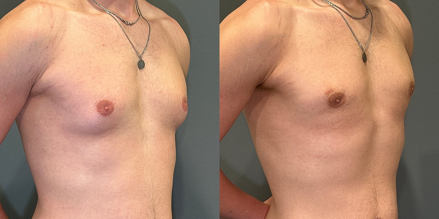 Gynecomastia Before & After