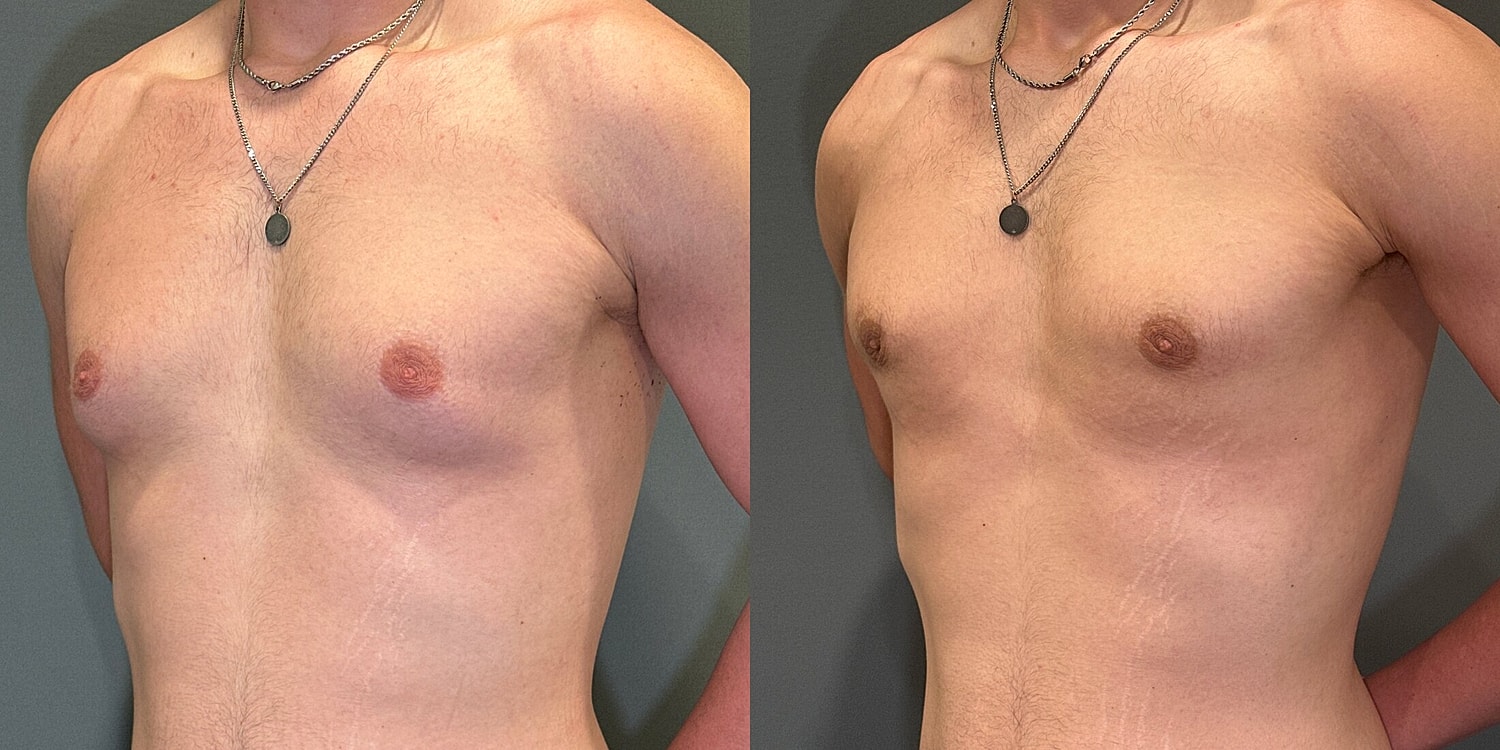 Gynecomastia Before & After