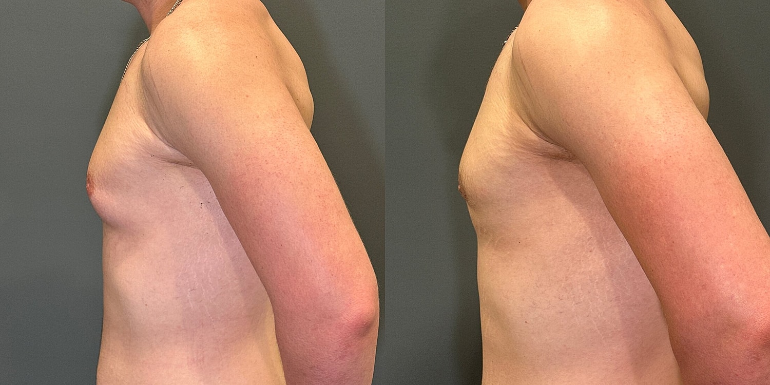 Gynecomastia Before & After
