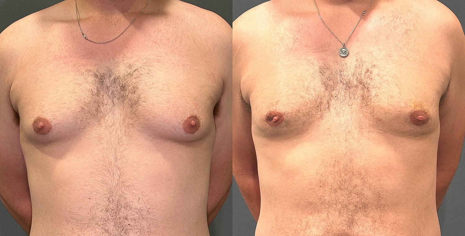 Gynecomastia Before & After