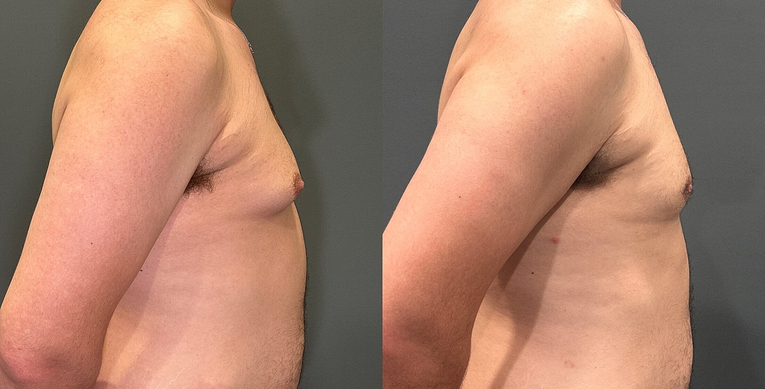 Gynecomastia Before & After