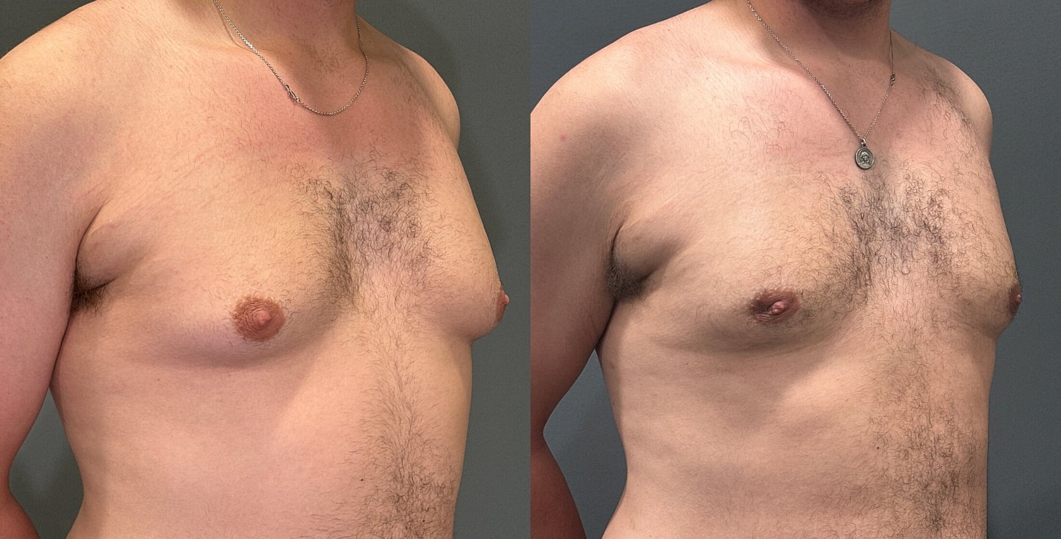 Gynecomastia Before & After