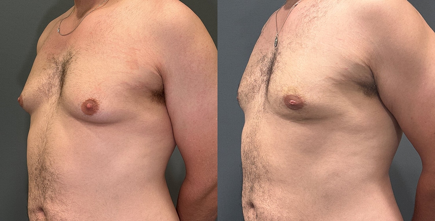 Gynecomastia Before & After