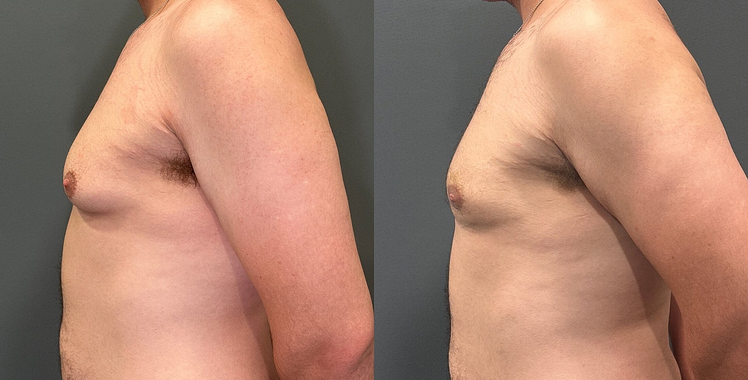 Gynecomastia Before & After