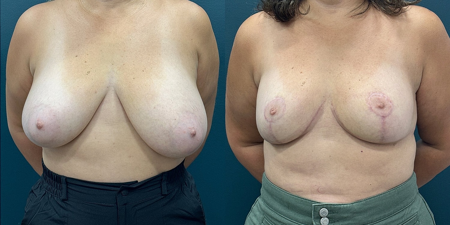 Breast Reduction Before & After