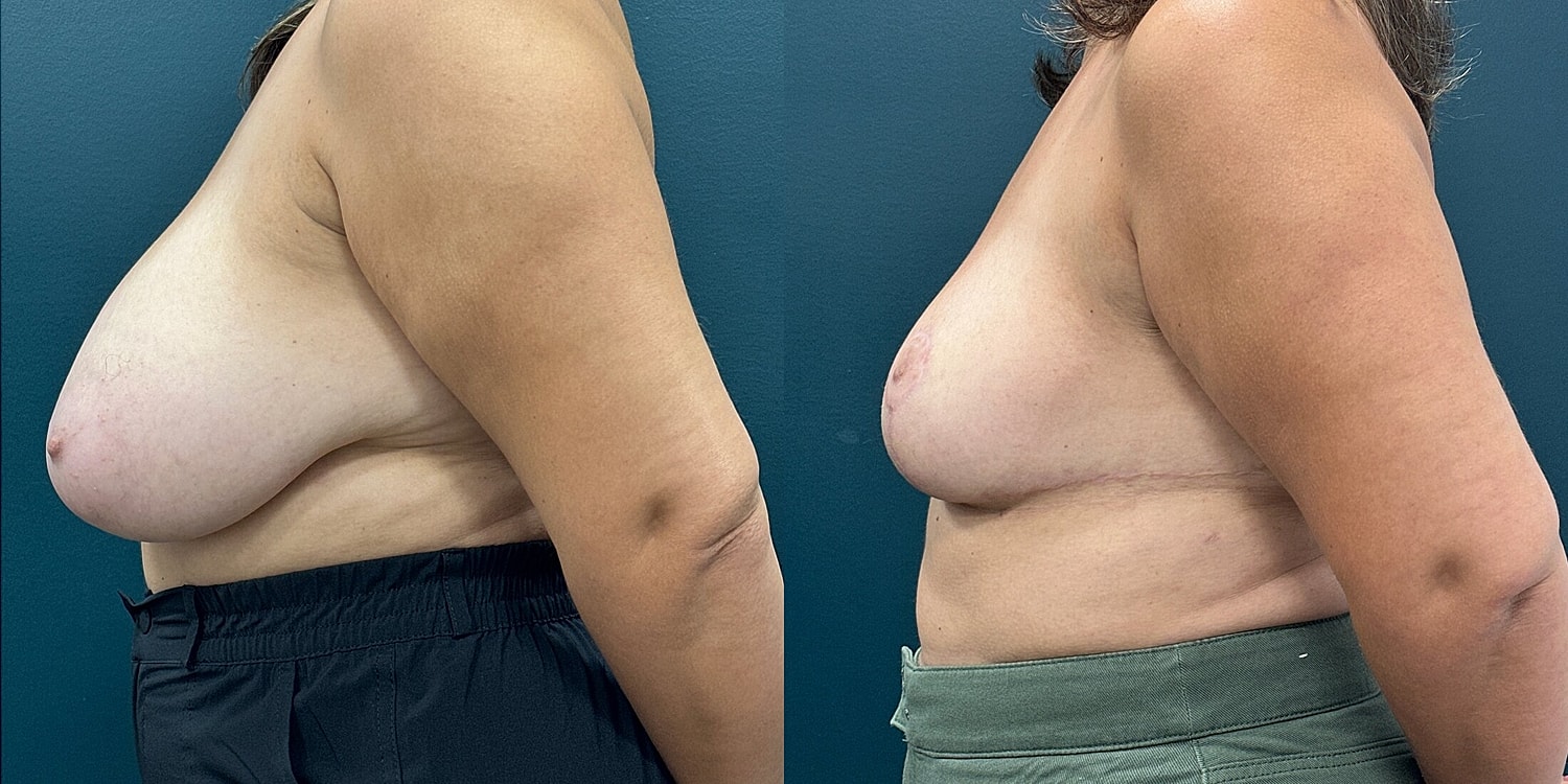 Breast Reduction Before & After