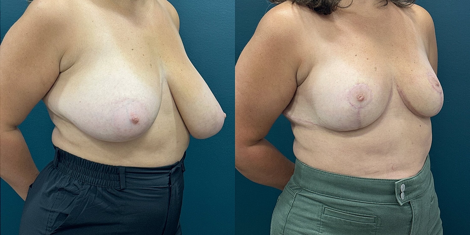 Breast Reduction Before & After