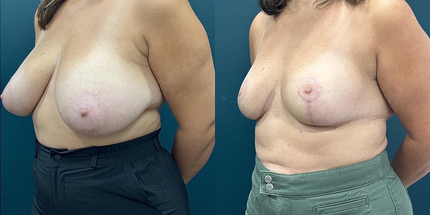 Breast Reduction Before & After