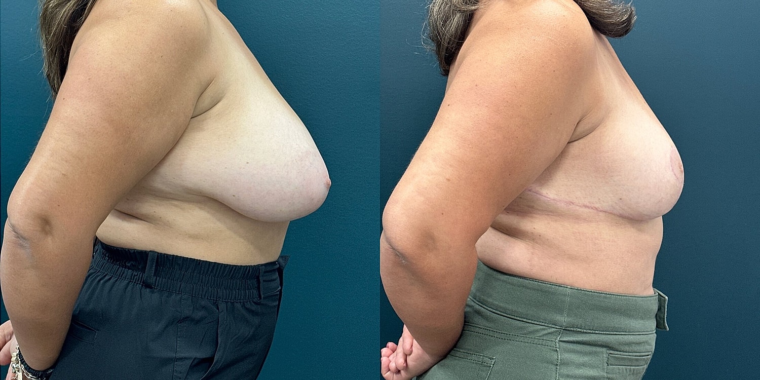 Breast Reduction Before & After