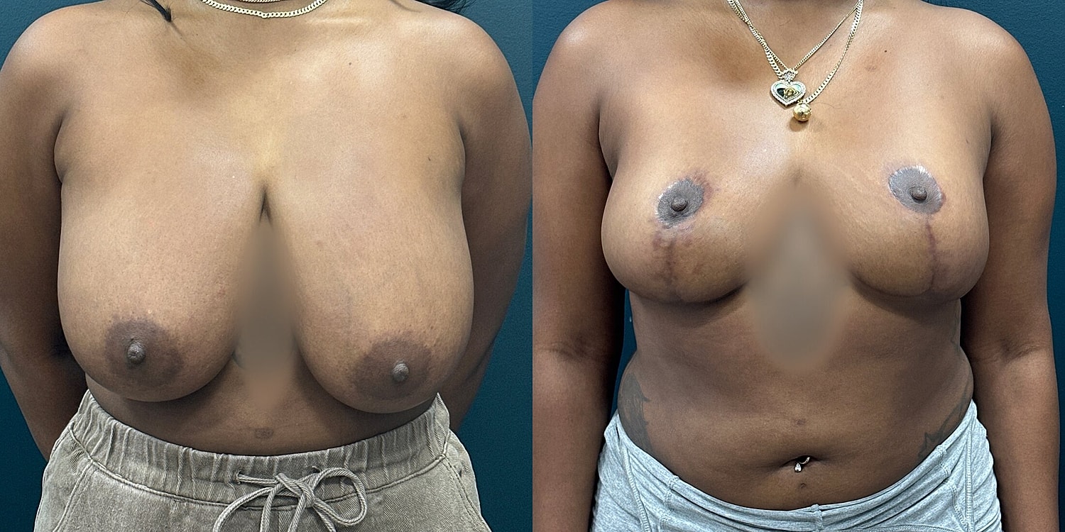 Breast Reduction Before & After