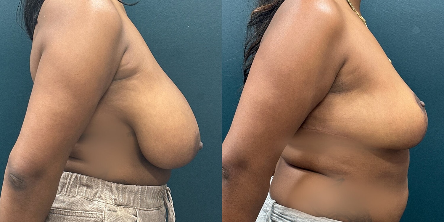 Breast Reduction Before & After