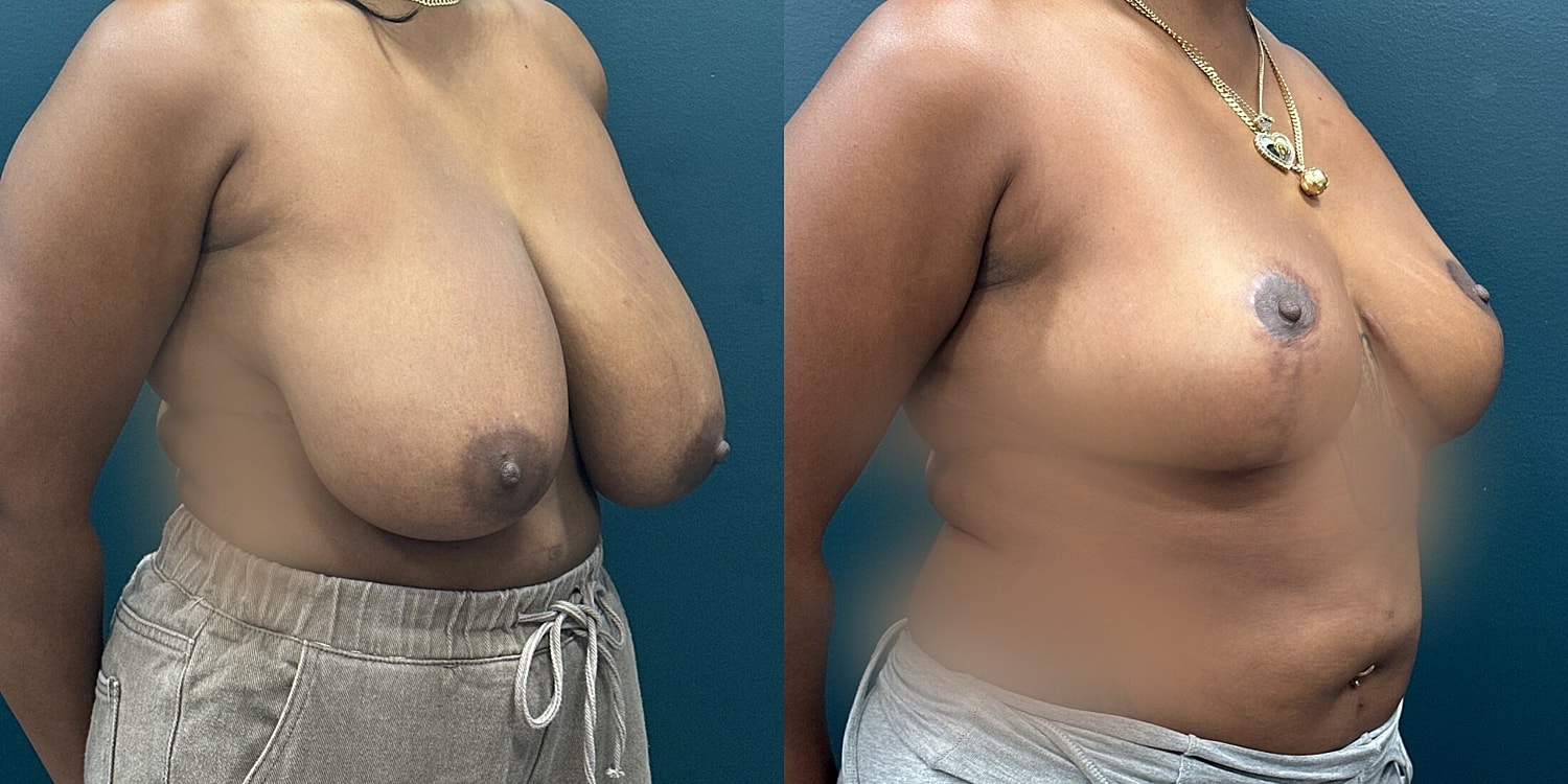 Breast Reduction Before & After