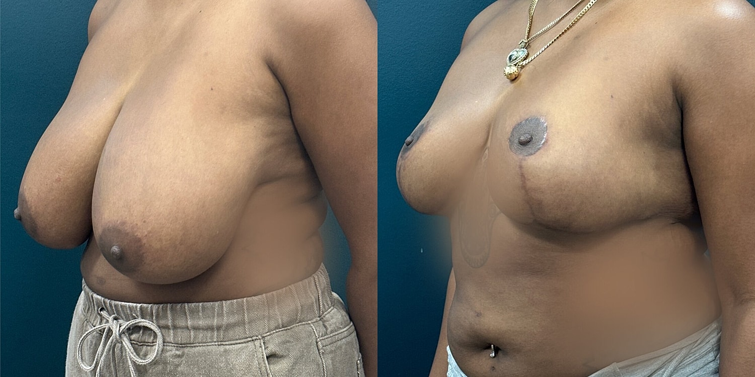 Breast Reduction Before & After