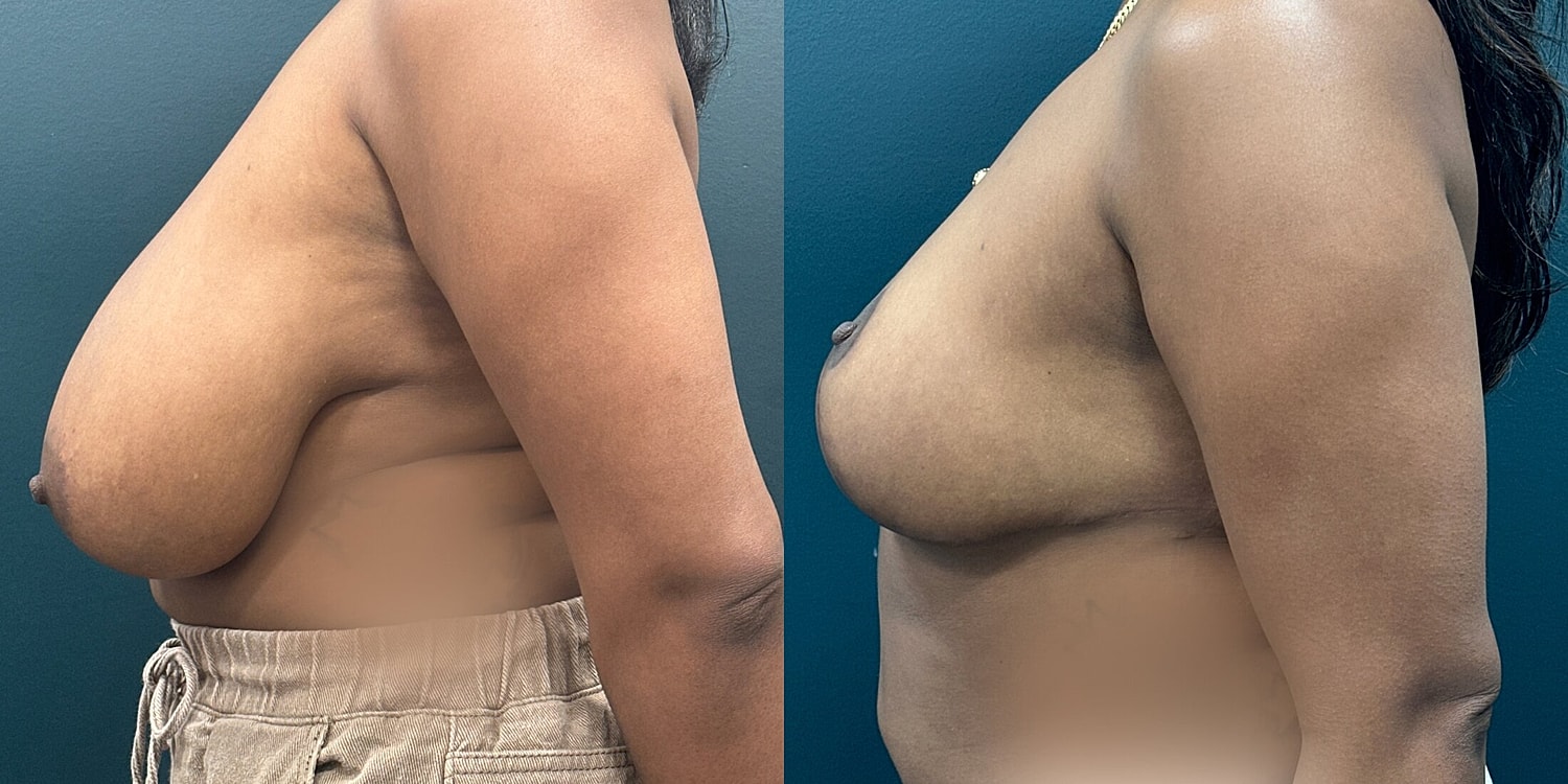 Breast Reduction Before & After