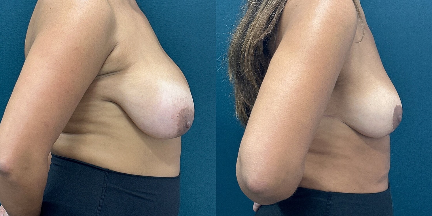 Breast Reduction Before & After