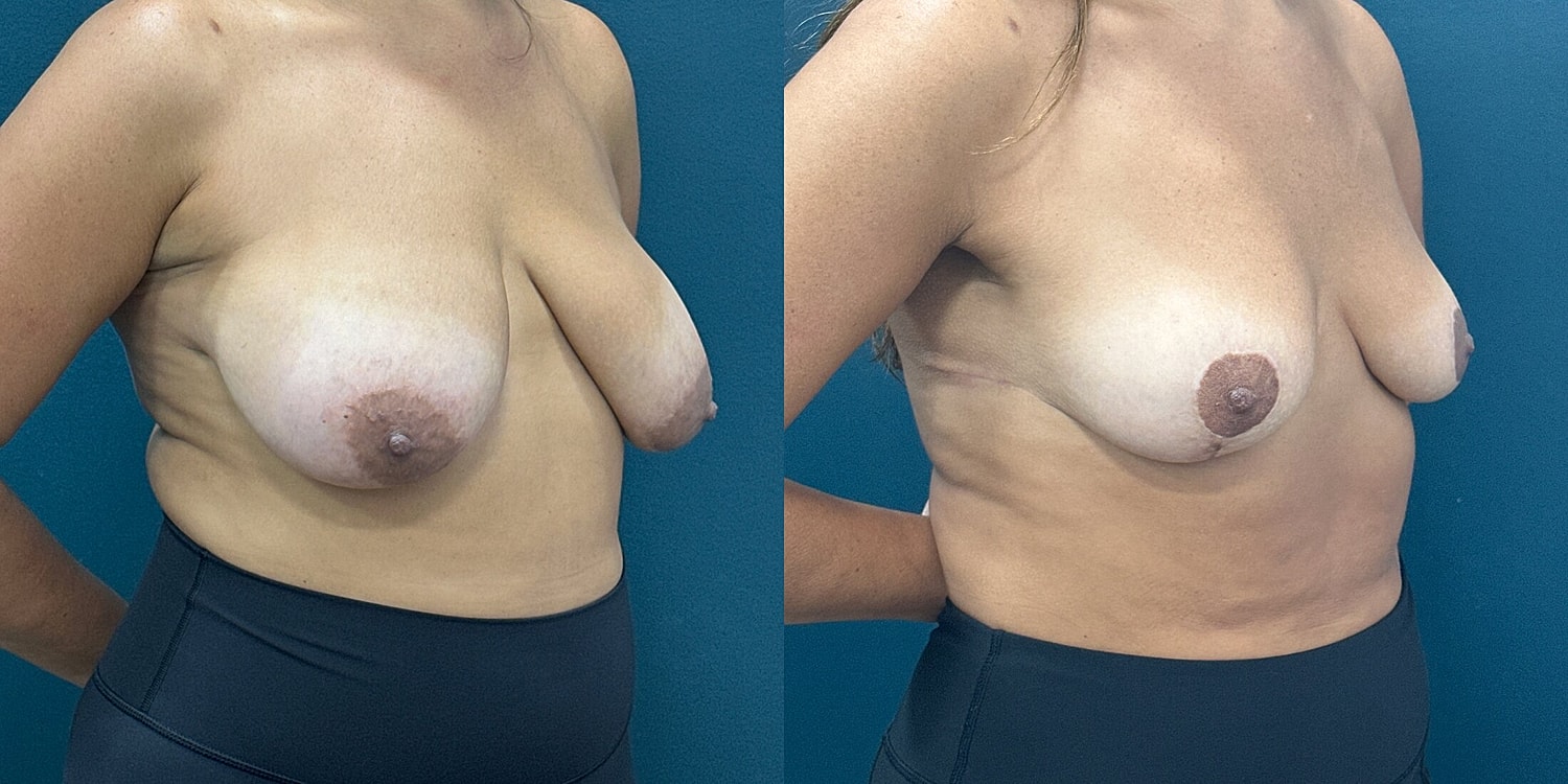 Breast Reduction Before & After