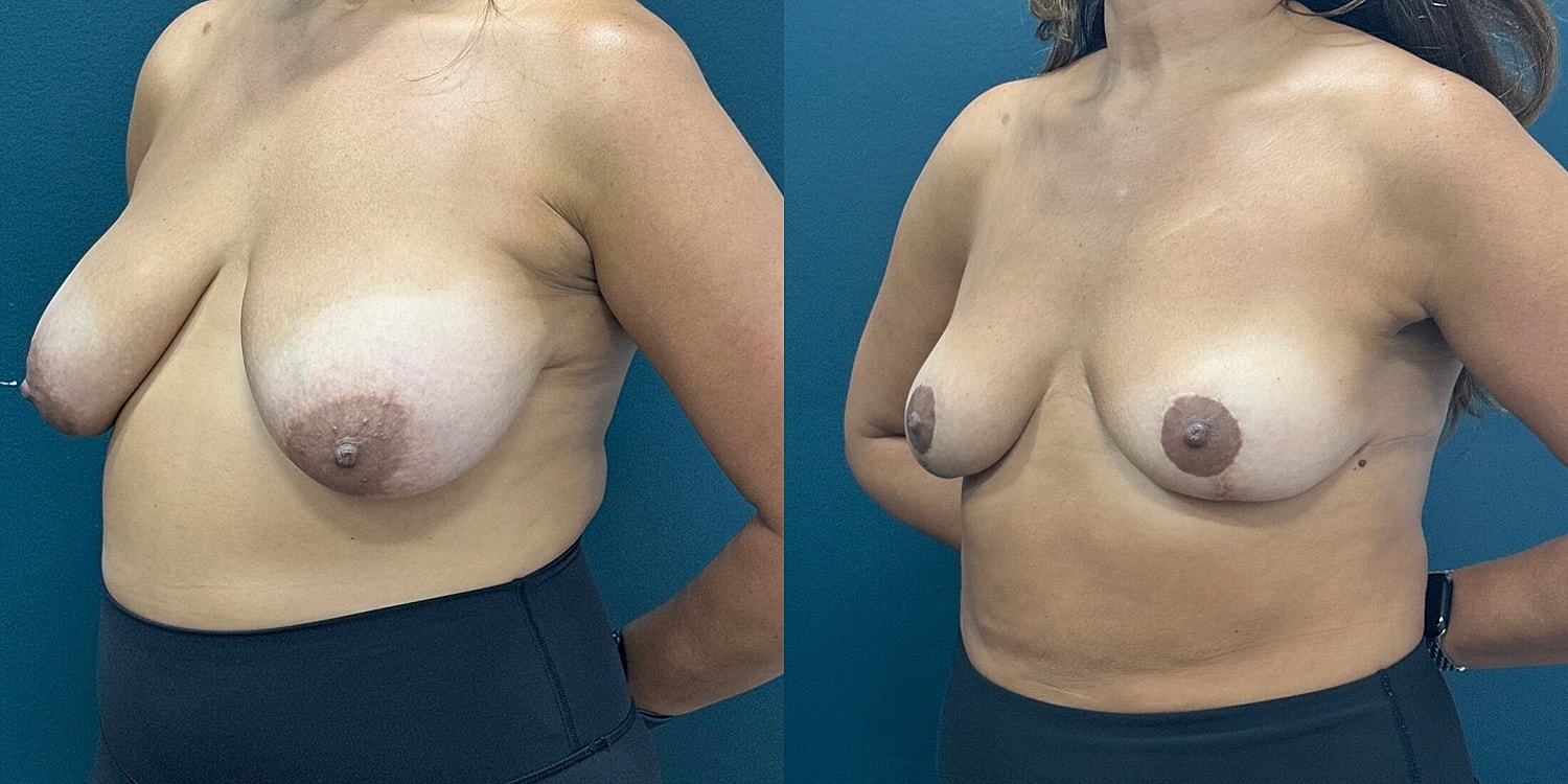 Breast Reduction Before & After