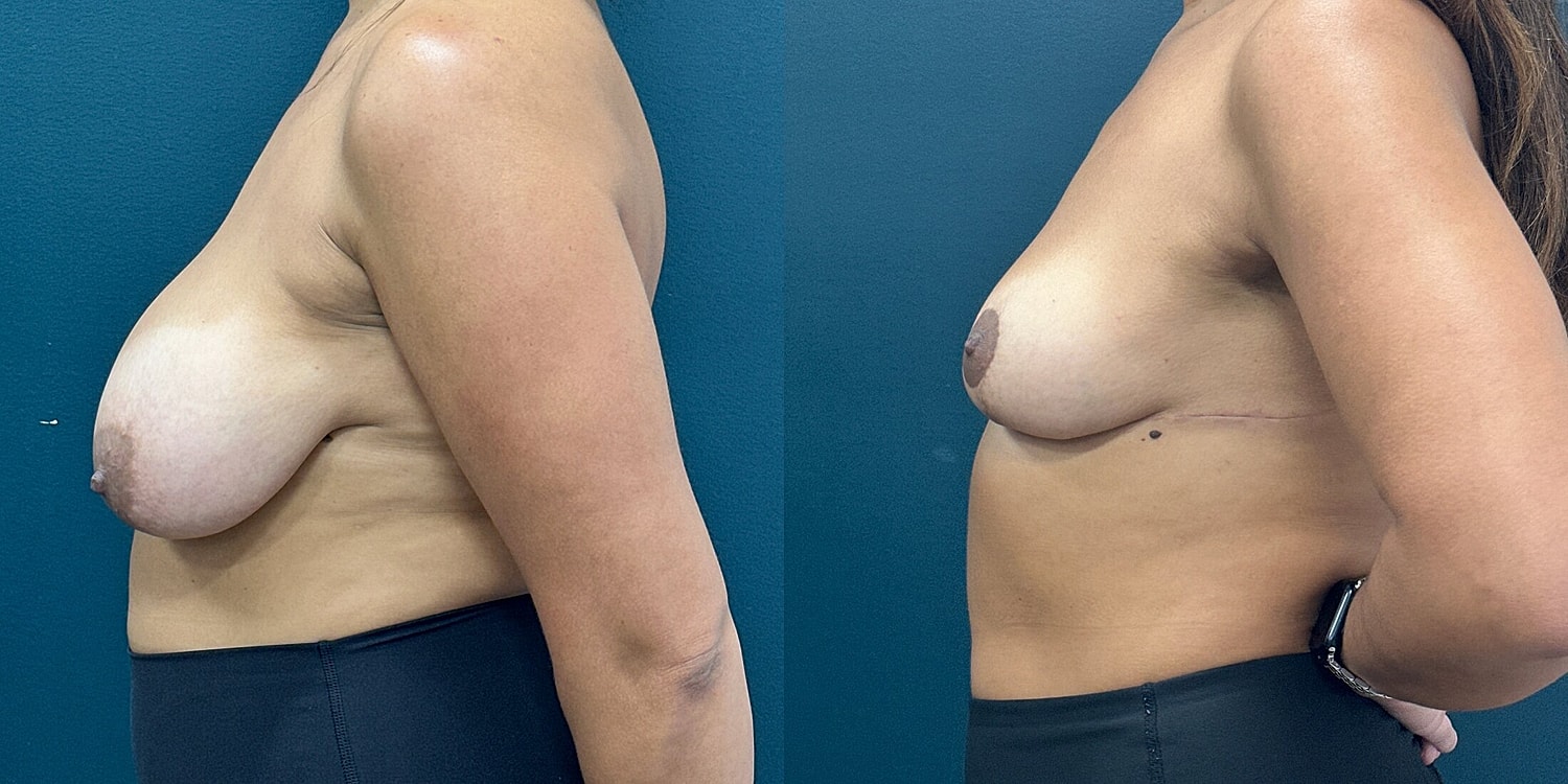 Breast Reduction Before & After