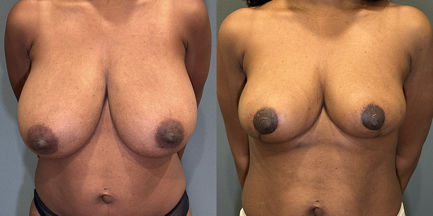 Breast Reduction Before & After