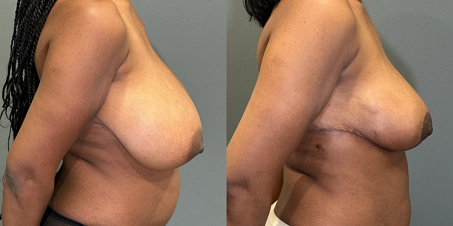 Breast Reduction Before & After