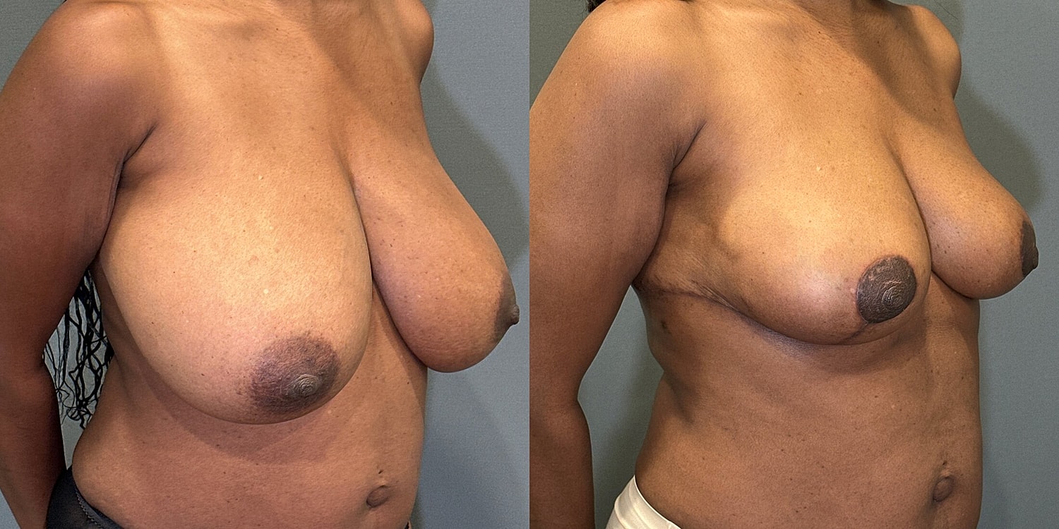 Breast Reduction Before & After