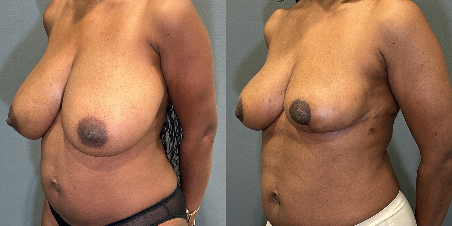Breast Reduction Before & After