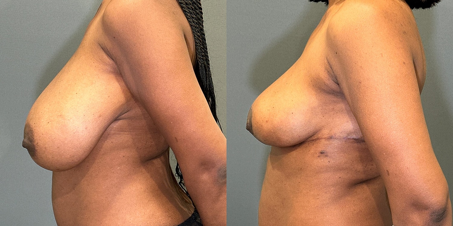 Breast Reduction Before & After