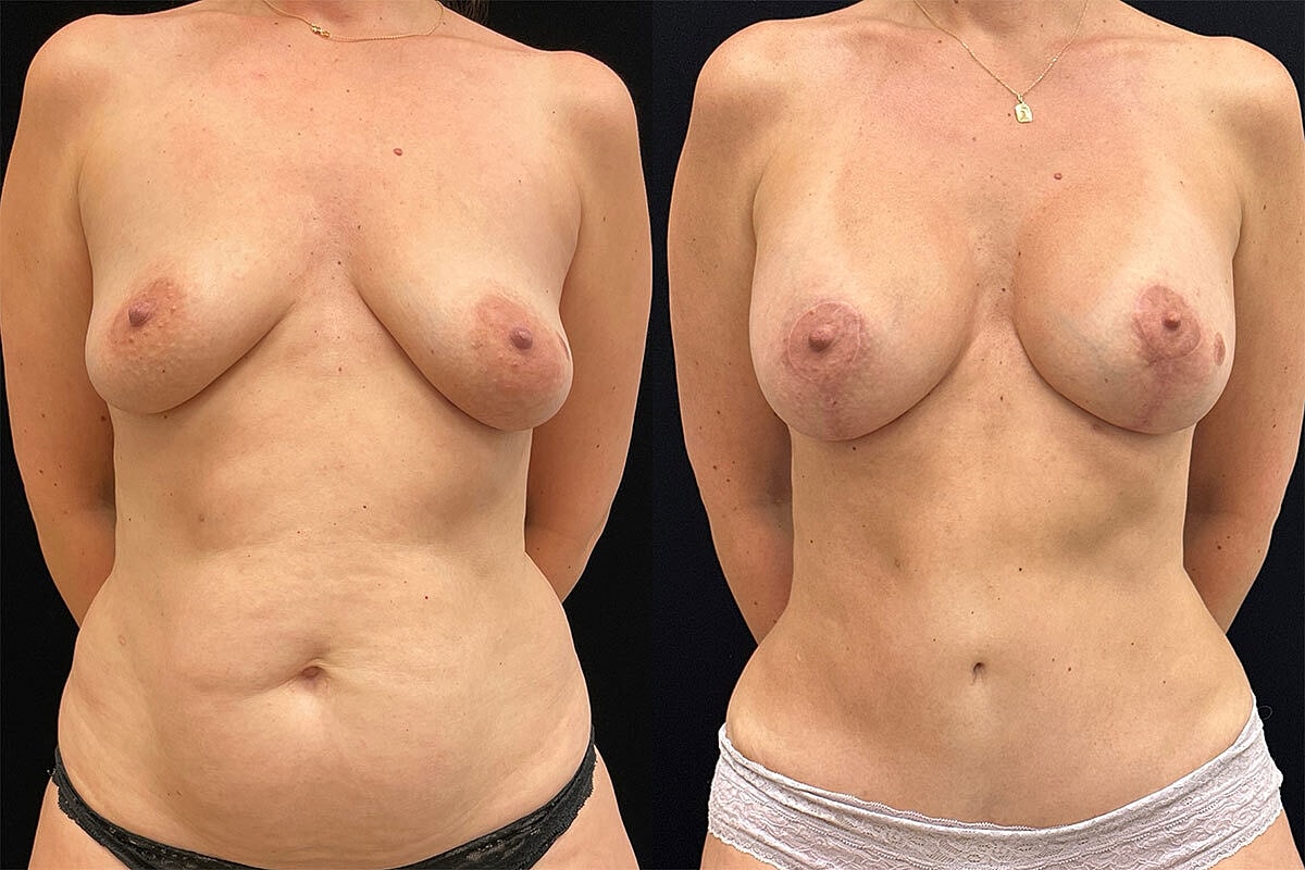 Breast Lift Before & After