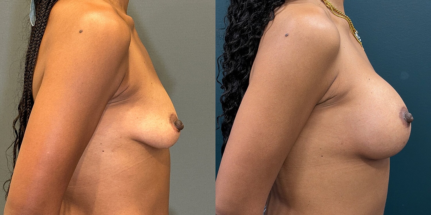Breast Lift Before & After