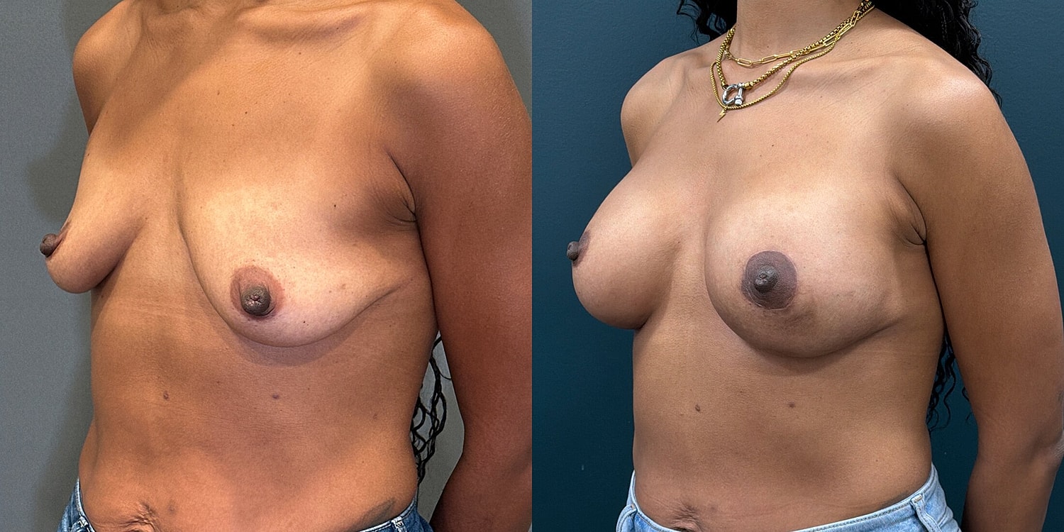 Breast Lift Before & After