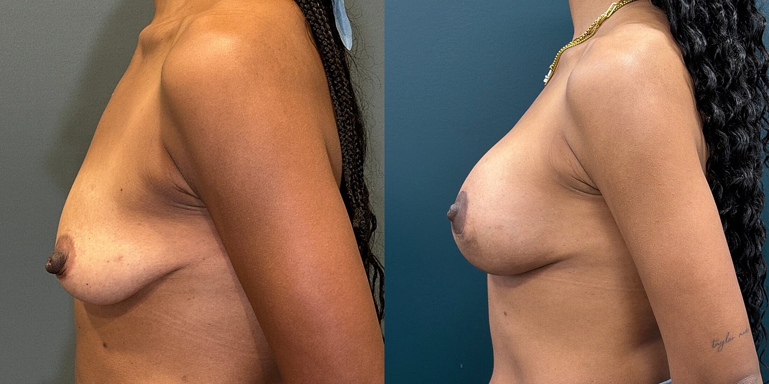 Breast Lift Before & After