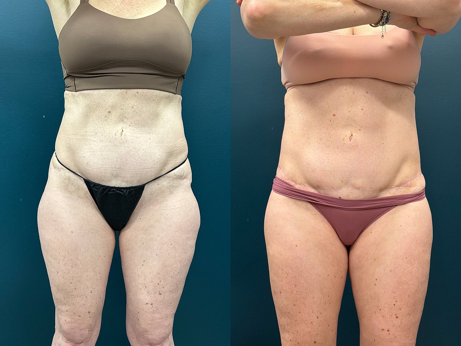 Lower Body Lift Before & After