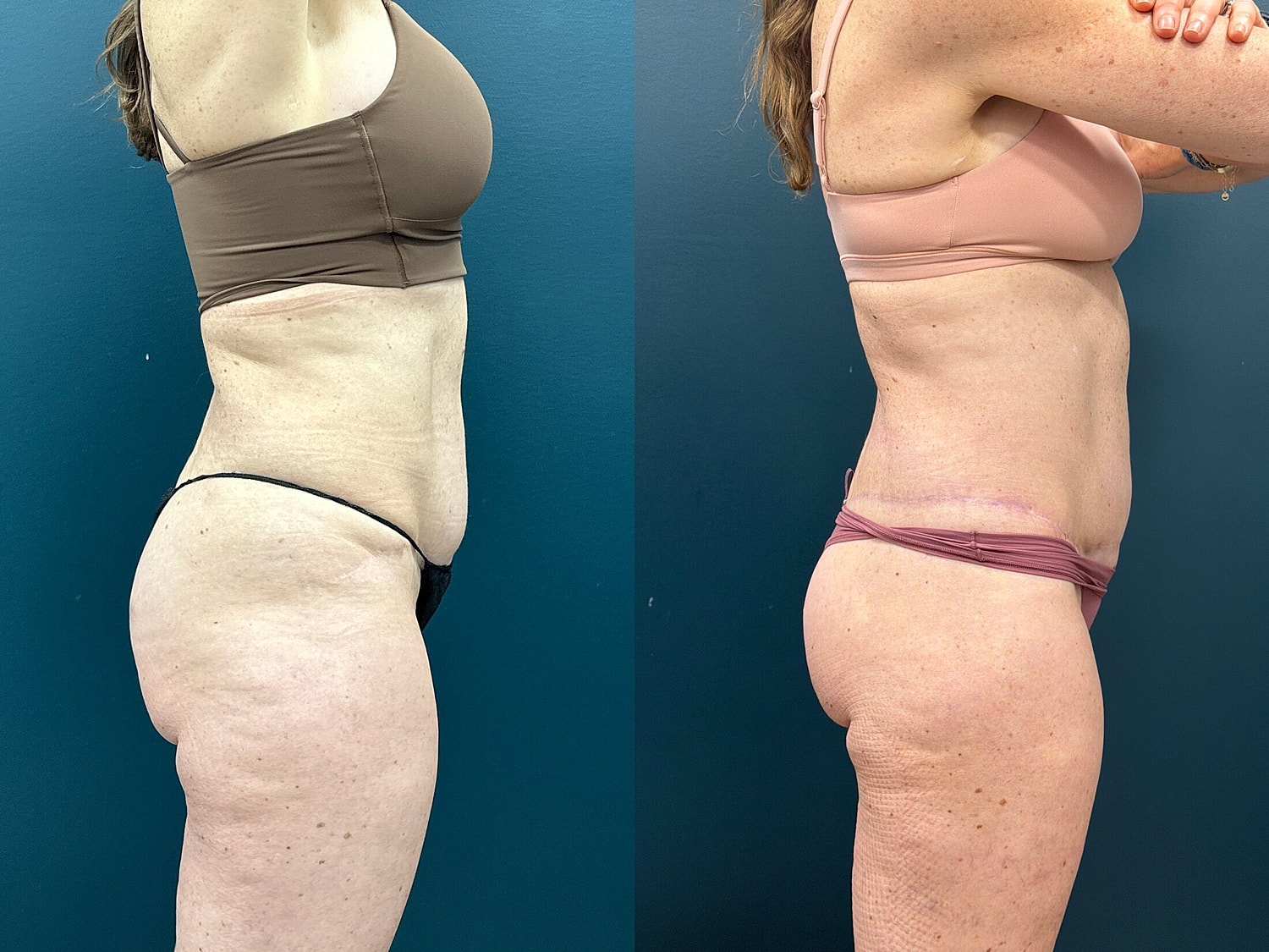 Lower Body Lift Before & After