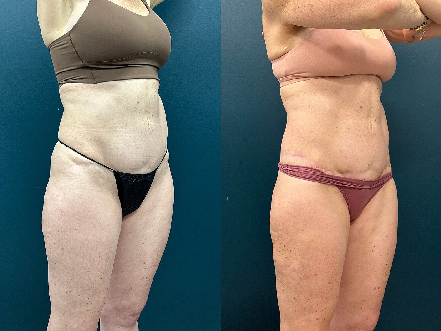 Lower Body Lift Before & After