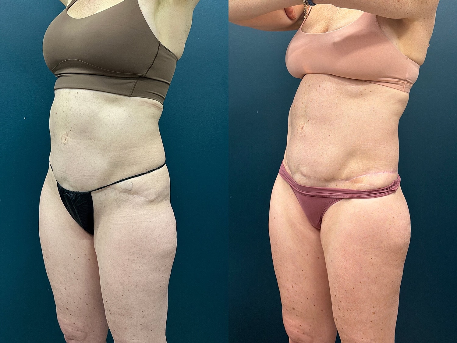 Lower Body Lift Before & After