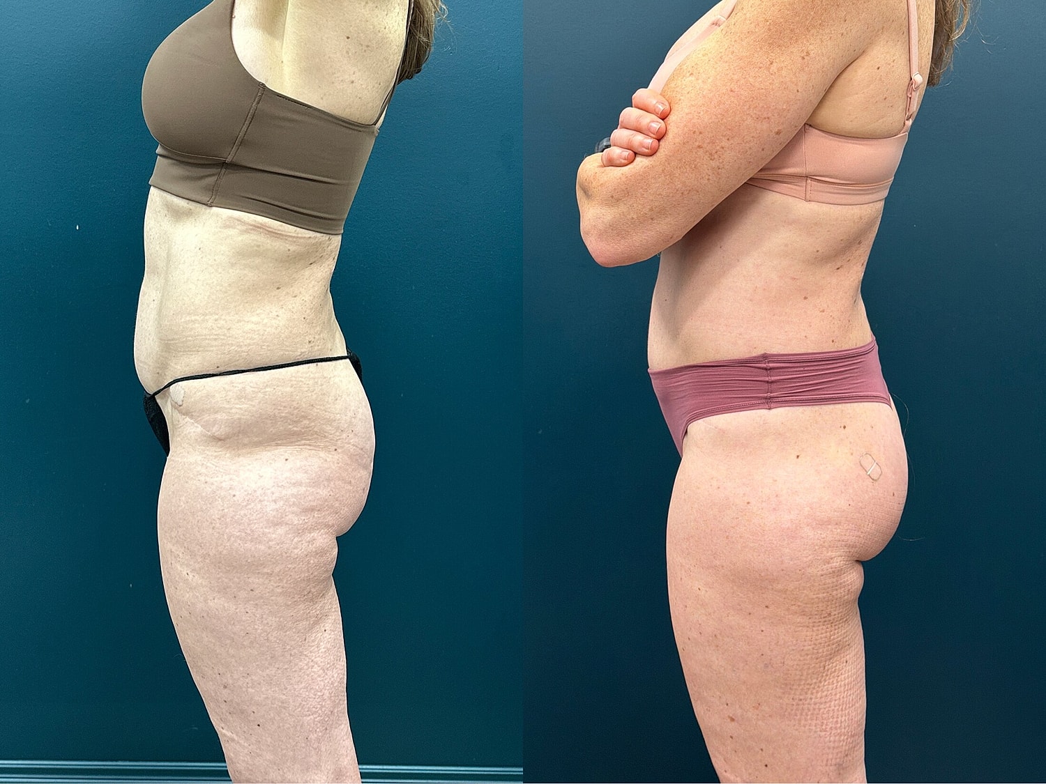 Lower Body Lift Before & After